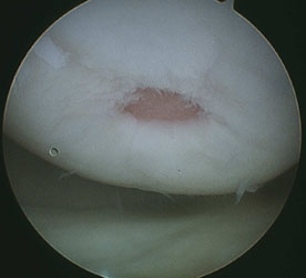 Damaged cartilage before microfracture