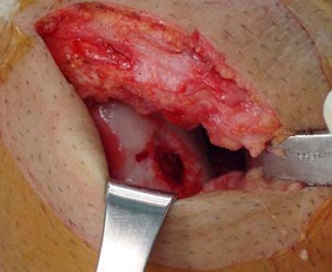 Shows incision used in ACI surgery