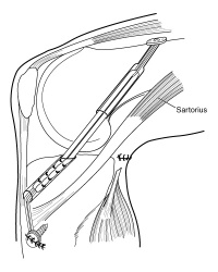 ACLR side drawing