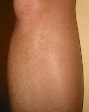 incision scar front