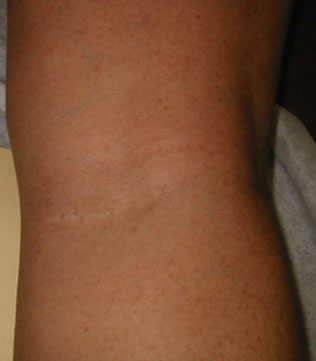 incision scar back
