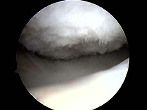 Damaged Knee Cartilage