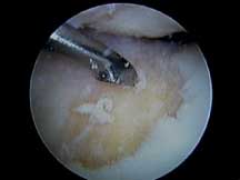 Microfracture Image 2