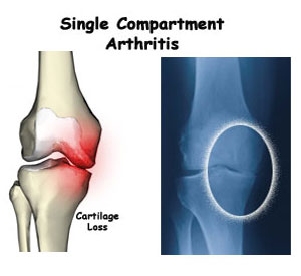 Unicompartmental arthritis