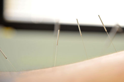 Acupuncture better than drugs