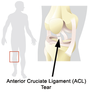 ACL Tear