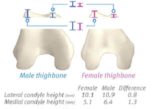 Male vs. Female Knee Shape