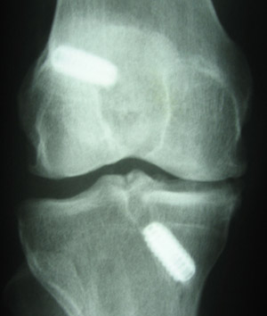 Old Interference Screws Visible on X-Ray