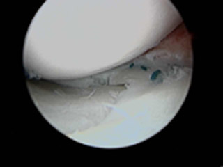 Repaired Meniscus