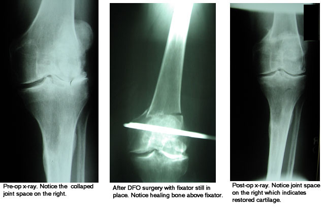 distal femoral osteotomy