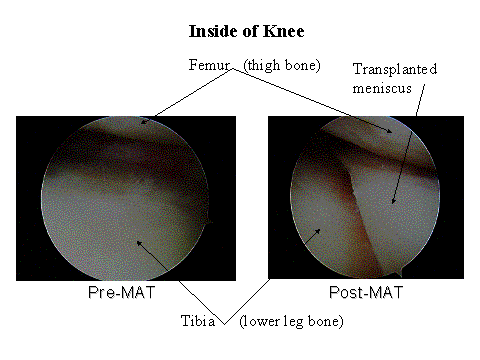 Meniscal Allograft Transplant before and after