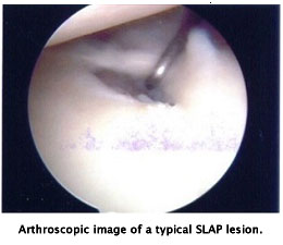 SLAP lesion 