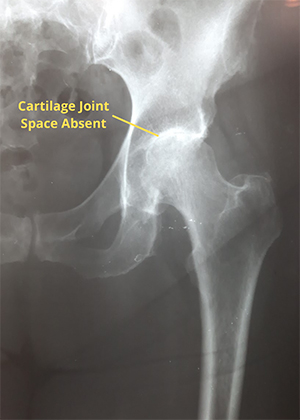 Cortisone Image