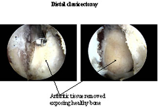 Distal Clavicectomy Images