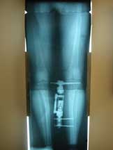 xray of leg with fixator in place
