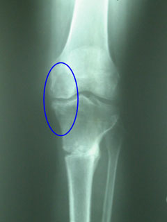 X-ray of same knee after HTO