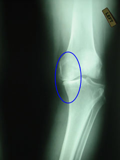 X-ray before HTO