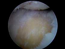 Microfracture Image 1 rthroscopic image of damaged cartilage in the knee. The darker areas are bone where the whiter cartilage has worn away.