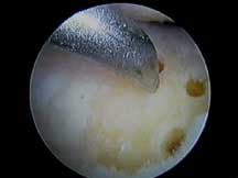 Microfracture Image 3