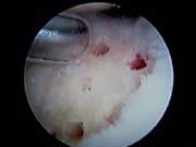 Microfracture Image 4