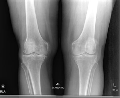 X-ray of knee with medial damage