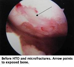 Patient 1 before HTO