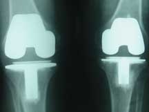 X-ray of knee replacement