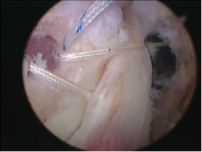 Rotator Cuff Repair