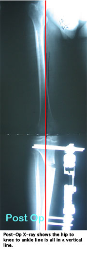 Standing X-ray post-op